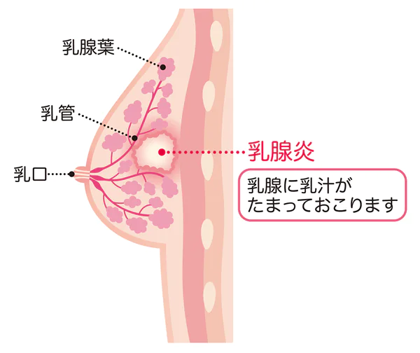 乳腺炎