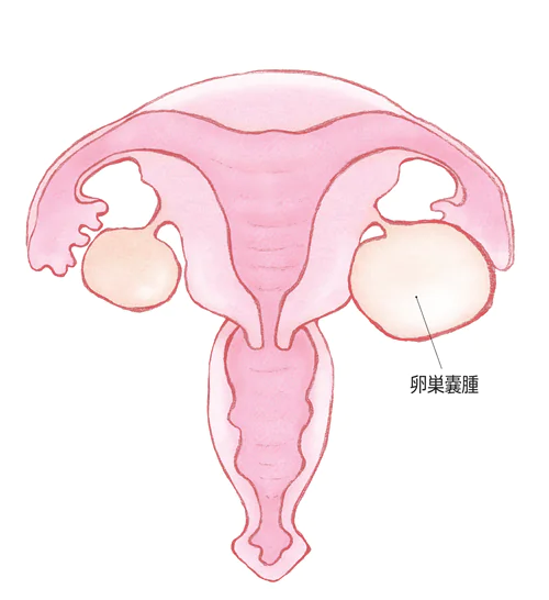 卵巣腫瘍（卵巣嚢腫）とは