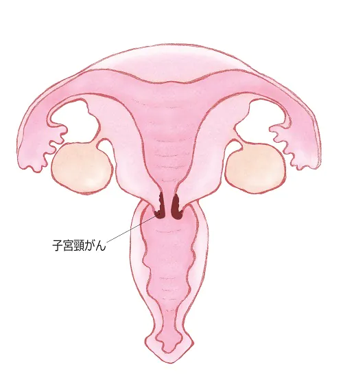 子宮頸がんとは